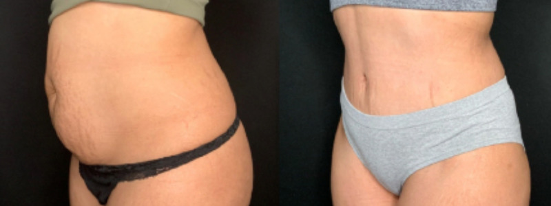 Patient #59852: Tummy Tuck Combine Image