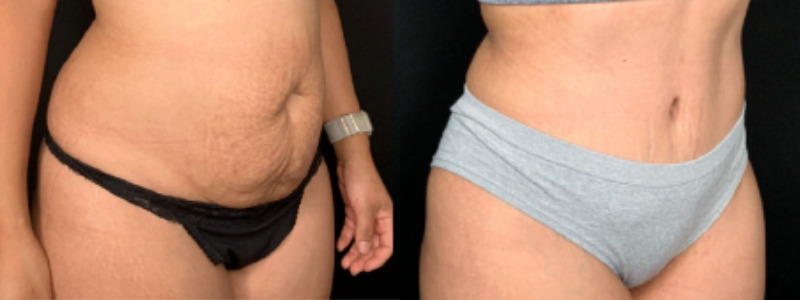 Patient #59852: Tummy Tuck Combine Image