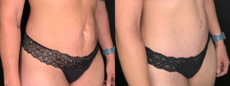 Patient #45863: Tummy Tuck with Liposuction to Hips, Flanks, Thighs Combine Image