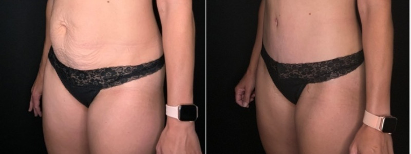 Patient #35698: Tummy Tuck with Liposuction to Flanks Combine Image