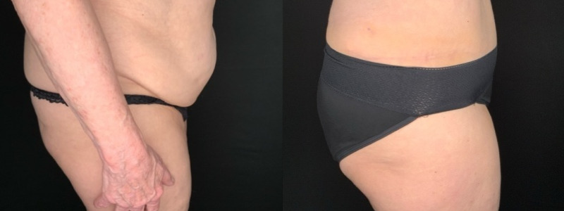 Patient #45682: Tummy Tuck with Liposuction to Flanks Combine Image
