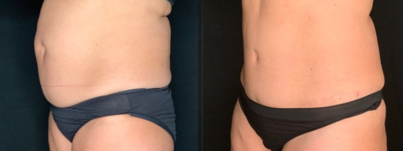 Patient #62875 Tummy Tuck with Liposuction to Back, Hips, Abdomen and Flanks Combine Image