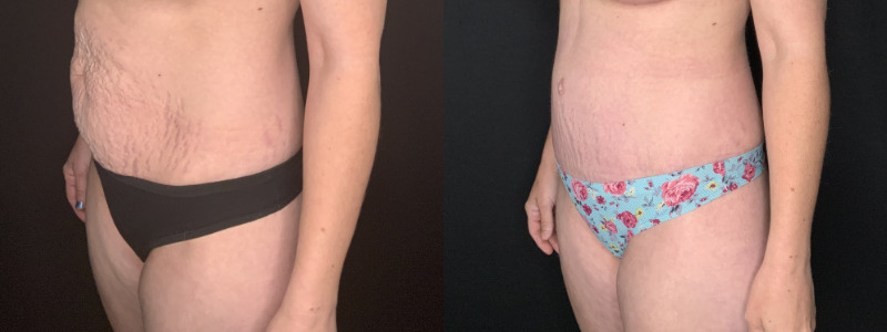 Patient #54673-2: Tummy Tuck with Liposculpture to Flanks and Axillary Rolls Combine Image