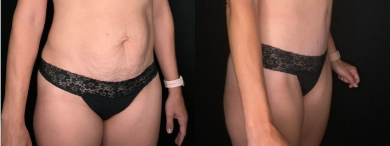 Patient #35698: Tummy Tuck with Liposuction to Flanks Combine Image