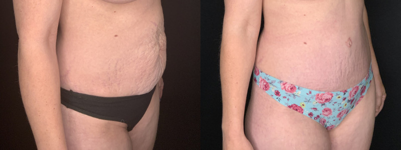Patient #54673-2: Tummy Tuck with Liposculpture to Flanks and Axillary Rolls Combine Image