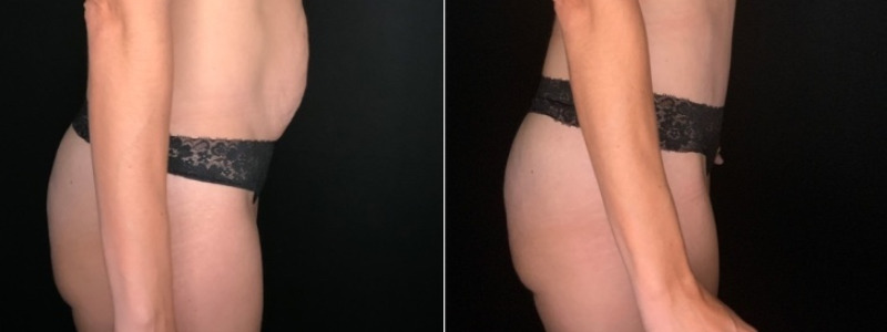 Patient #35698: Tummy Tuck with Liposuction to Flanks Combine Image