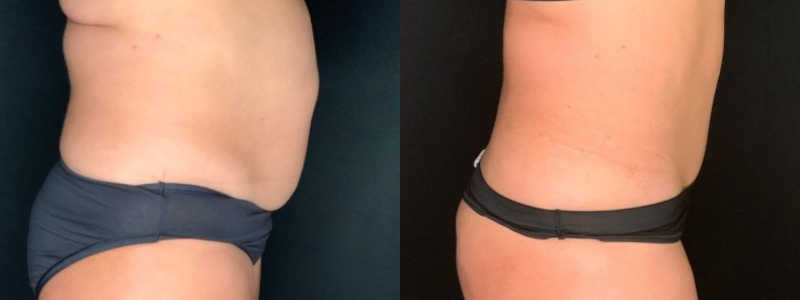 Patient #62875 Tummy Tuck with Liposuction to Back, Hips, Abdomen and Flanks Combine Image
