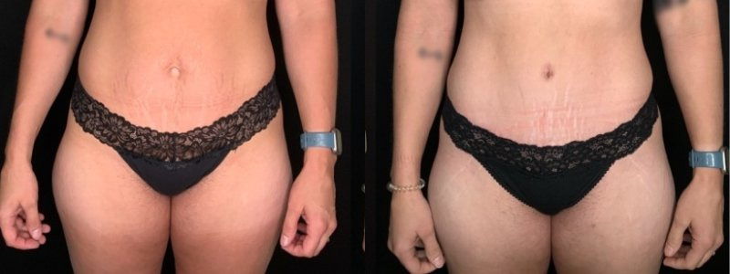 Patient #45863: Tummy Tuck with Liposuction to Hips, Flanks, Thighs Combine Image