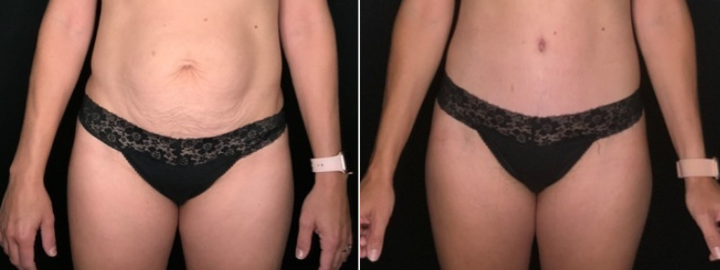 Patient #35698: Tummy Tuck with Liposuction to Flanks Combine Image
