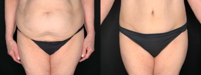 Patient #45682: Tummy Tuck with Liposuction to Flanks Combine Image