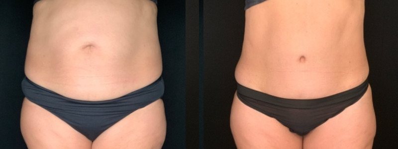 Patient #62875 Tummy Tuck with Liposuction to Back, Hips, Abdomen and Flanks Combine Image