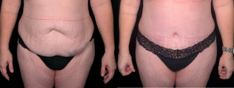 Patient #59874: Tummy Tuck Combine Image