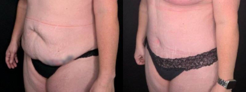 Patient #59874: Tummy Tuck Combine Image