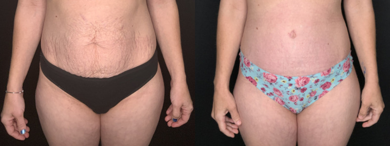 Patient #54673-2: Tummy Tuck with Liposculpture to Flanks and Axillary Rolls Combine Image