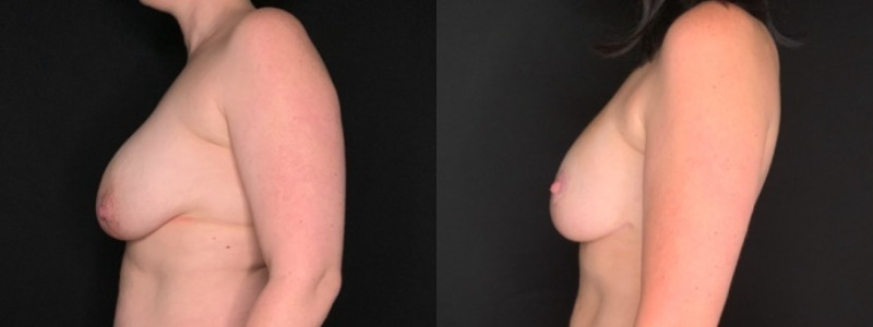 Patient #25487: Breast Implant Exchange with Lift and Capsulectomy Combine Image