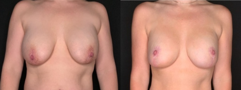 Patient #25487: Breast Implant Exchange with Lift and Capsulectomy Combine Image
