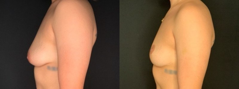 Patient #39145: Breast Lift Combine Image