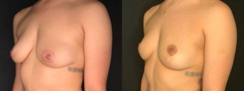 Patient #39145: Breast Lift Combine Image