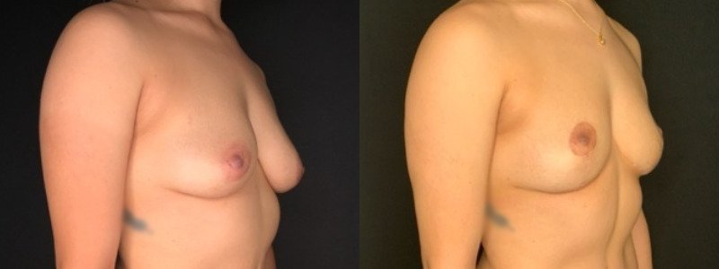 Patient #39145: Breast Lift Combine Image