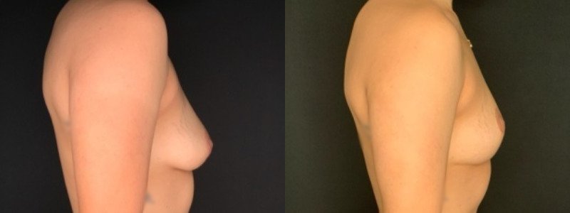 Patient #39145: Breast Lift Combine Image