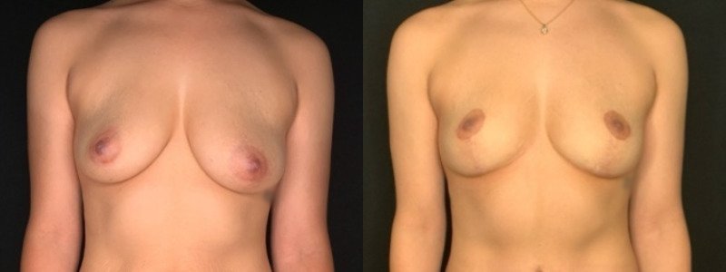 Patient #39145: Breast Lift Combine Image