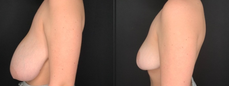 Patient #71289: Breast Reduction Combine Image
