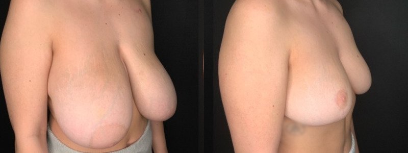 Patient #71289: Breast Reduction Combine Image