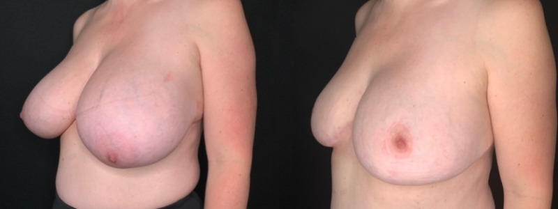 Patient #62587: Breast Reduction Combine Image