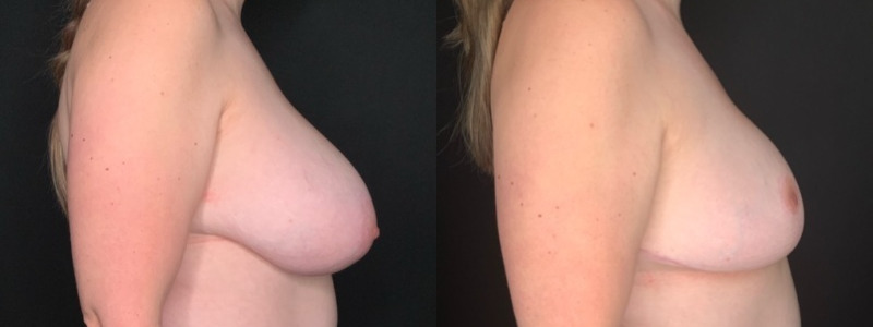 Patient #62587: Breast Reduction Combine Image