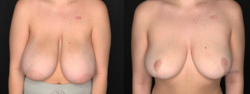 Patient #71289: Breast Reduction Combine Image