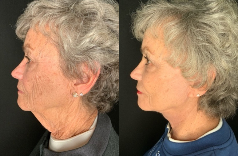 Patient #27548: Facelift with Facial Fat Injections Combine Image