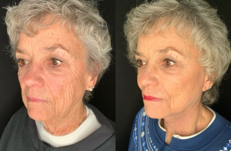 Patient #27548: Facelift with Facial Fat Injections Combine Image