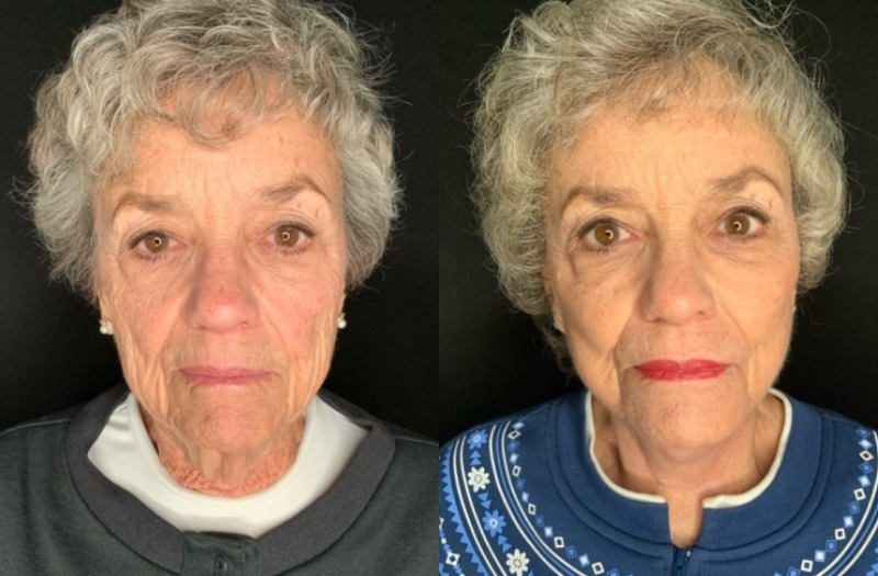 Patient #27548: Facelift with Facial Fat Injections Combine Image