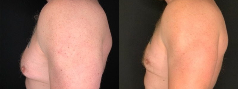 Patient #25879: Gynecomastia Combine Image