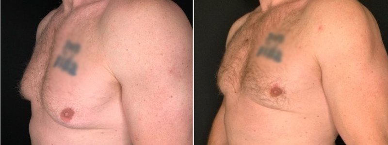 Patient #25879: Gynecomastia Combine Image