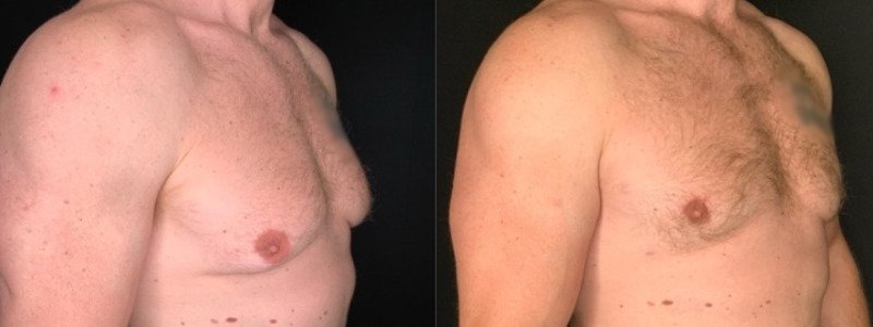 Patient #25879: Gynecomastia Combine Image