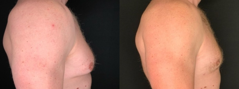 Patient #25879: Gynecomastia Combine Image