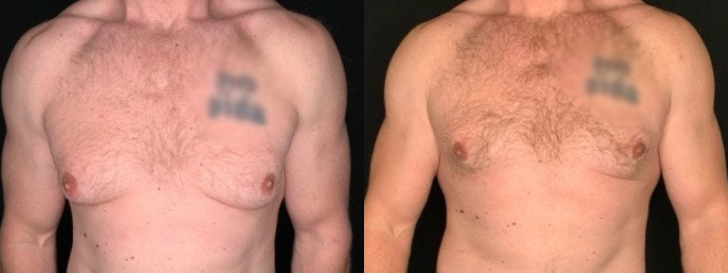 Patient #25879: Gynecomastia Combine Image
