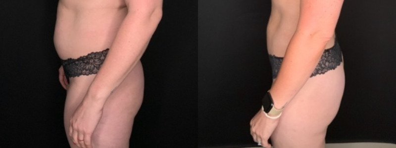 Patient #25487: Liposuction to the Abdomen, Back, Hips, Flanks, and Thighs Combine Image