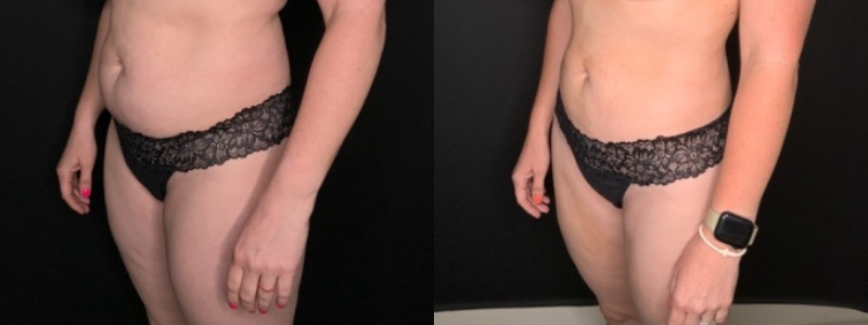 Patient #25487: Liposuction to the Abdomen, Back, Hips, Flanks, and Thighs Combine Image