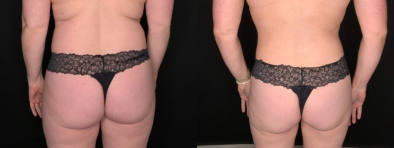 Patient #25487: Liposuction to the Abdomen, Back, Hips, Flanks, and Thighs Combine Image