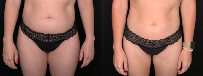 Patient #25487: Liposuction to the Abdomen, Back, Hips, Flanks, and Thighs Combine Image