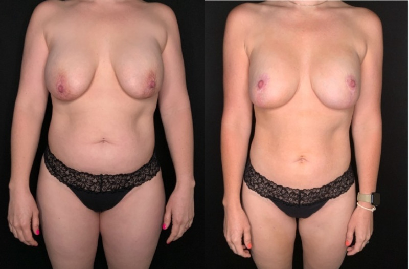 Patient #25487: Mommy Makeover Combine Image