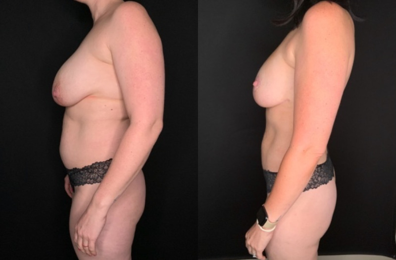 Patient #25487: Mommy Makeover Combine Image