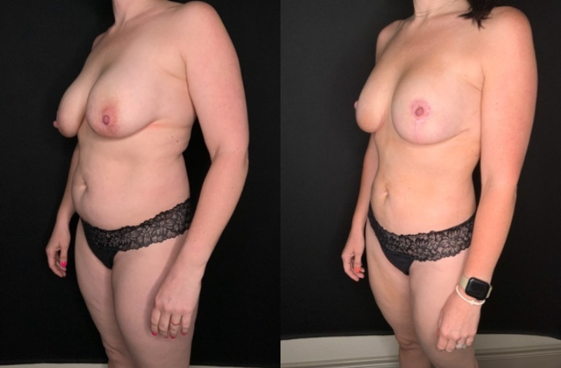 Patient #25487: Mommy Makeover Combine Image