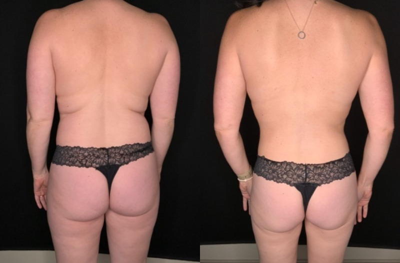 Patient #25487: Mommy Makeover Combine Image