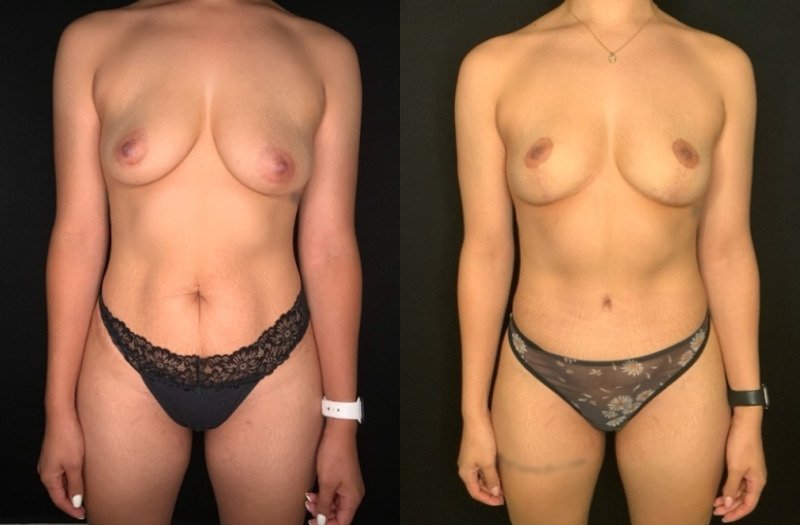 Patient #39145: Mommy Makeover Combine Image