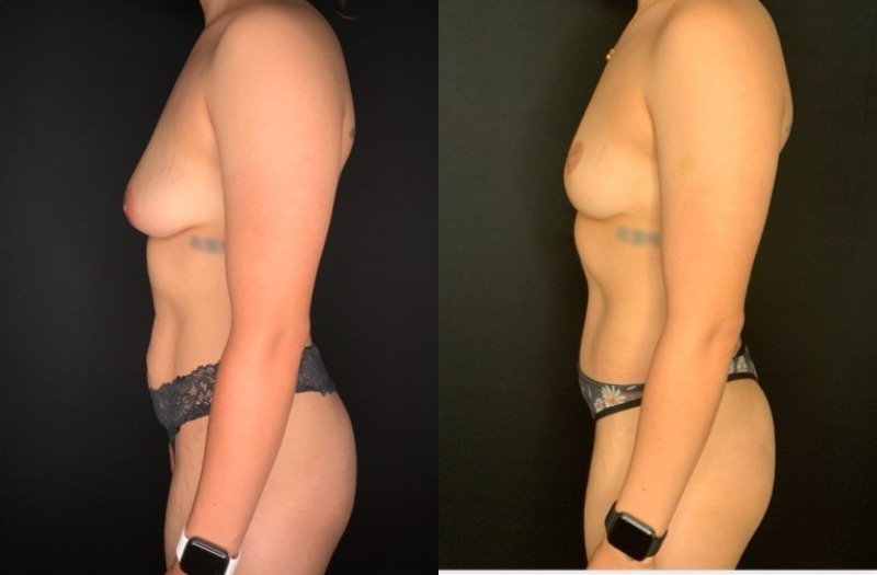 Patient #39145: Mommy Makeover Combine Image