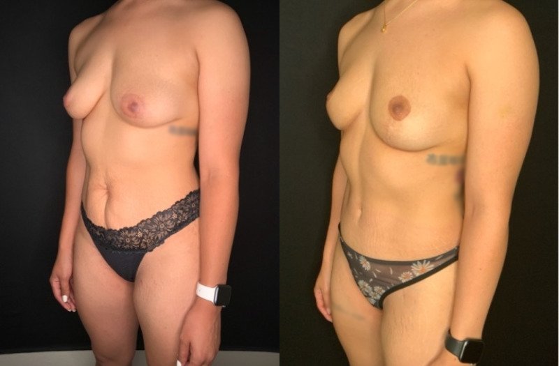 Patient #39145: Mommy Makeover Combine Image