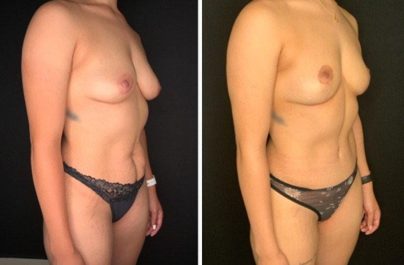 Patient #39145: Mommy Makeover Combine Image